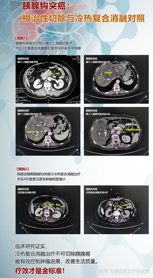 兩例胰腺鉤突癌術後3月療效對比根治性切除vs冷熱複合消融術