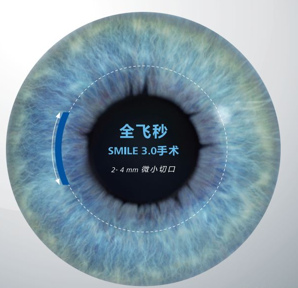 全飞秒问题欢迎咨询过来人的经验不会错干货绝对值得