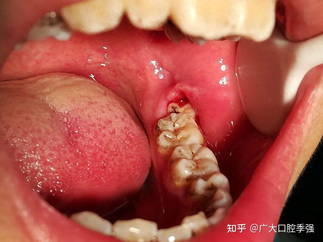 牙齿一吃冷热就酸痛无比，到底是怎么回事，需要拔掉吗？ - 知乎