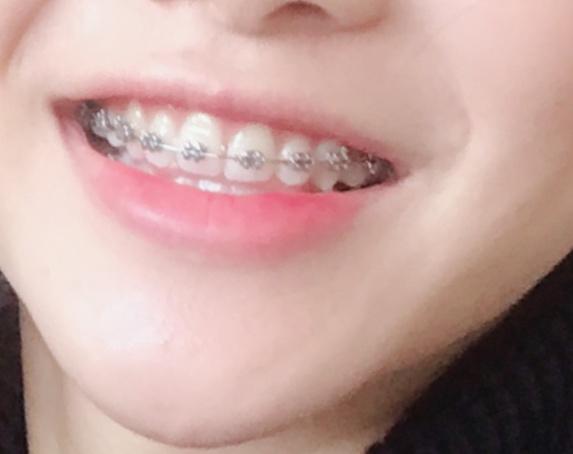 什么时候戴牙套都可以吗 v2-0218e56d2fe051abfc7a0ebf45d2f60a_r.jpg