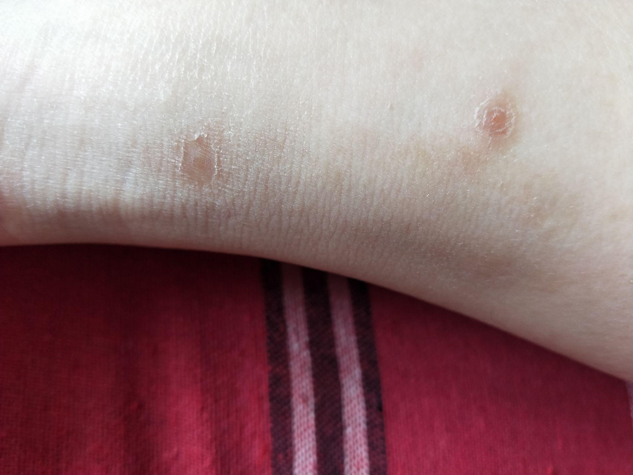 与丘疹性荨麻疹的"斗争" - 知乎