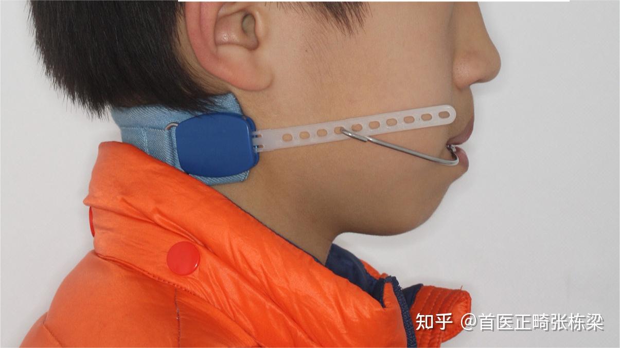 头帽口外弓适合哪些孩子用?早期矫正中如何导出下巴? - 知乎