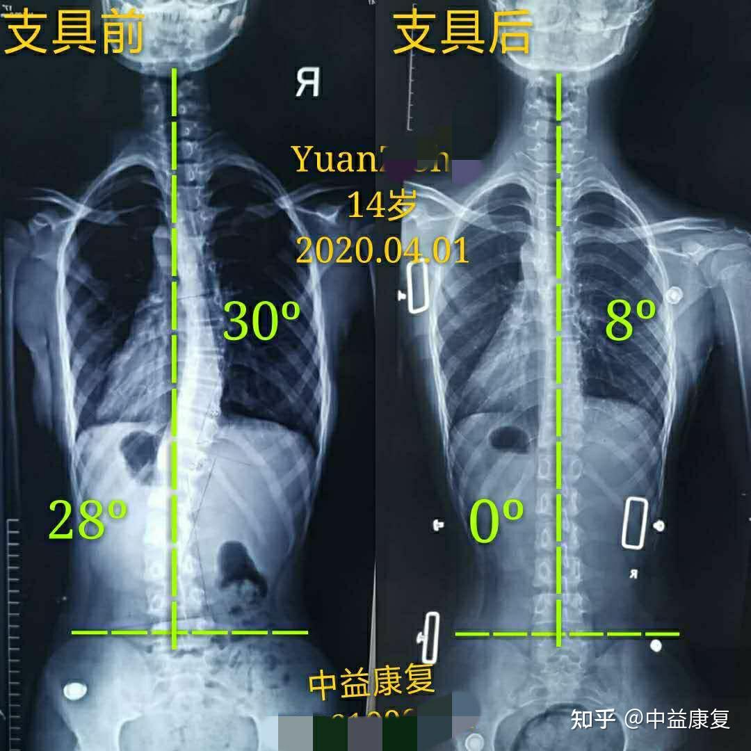 全國脊柱側彎支具哪裡做的好