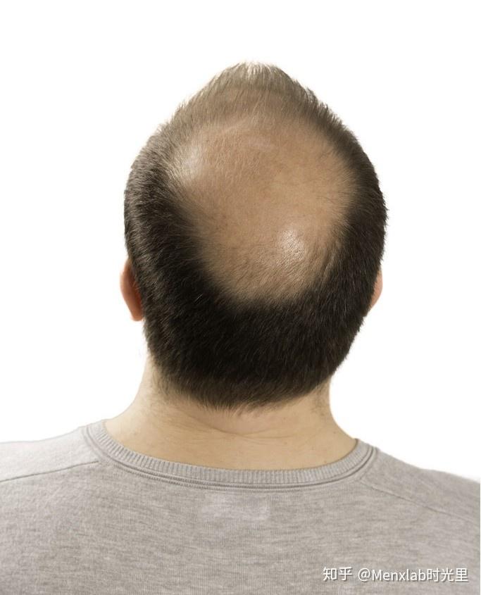 o型脱发一开始会就会发生在头顶,慢慢的头顶会逐渐稀疏,并且脱发区域