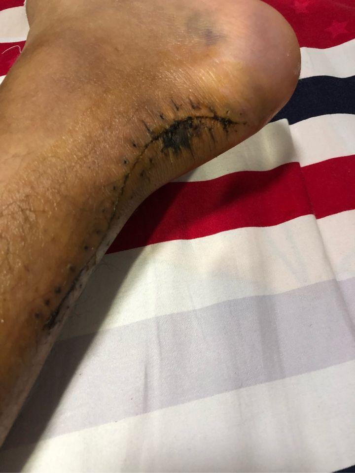 跟腱断裂手术恢复记录