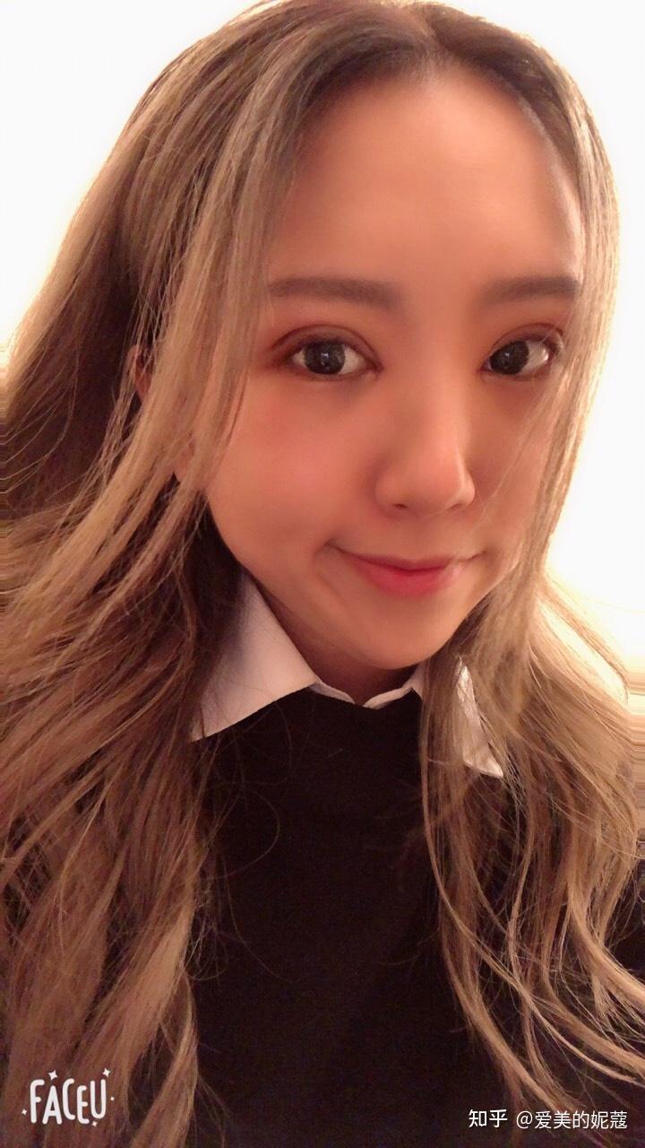 北京65mm自然款全切双眼皮的案例分享