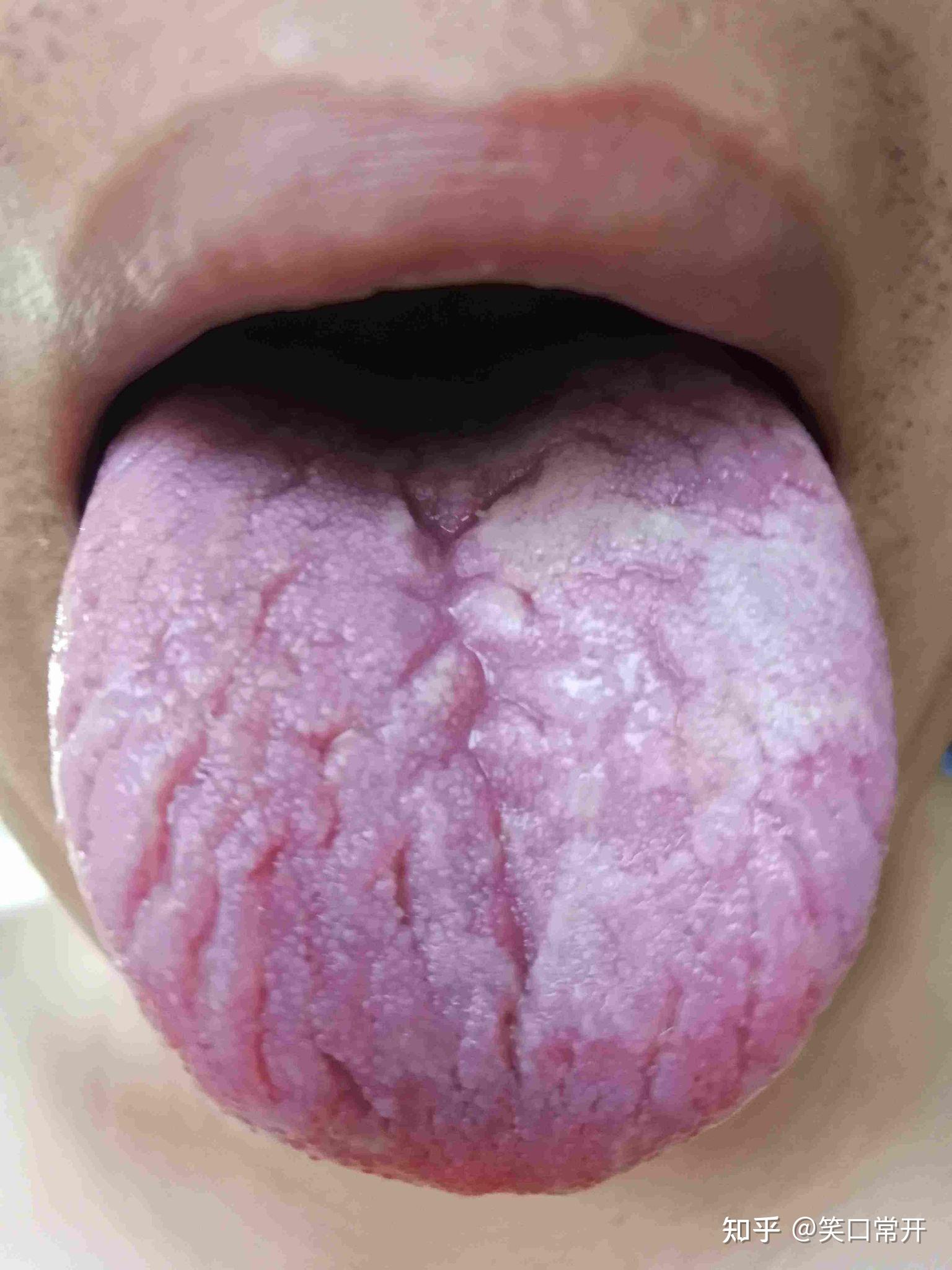 你的舌头上有裂纹吗？ - 知乎