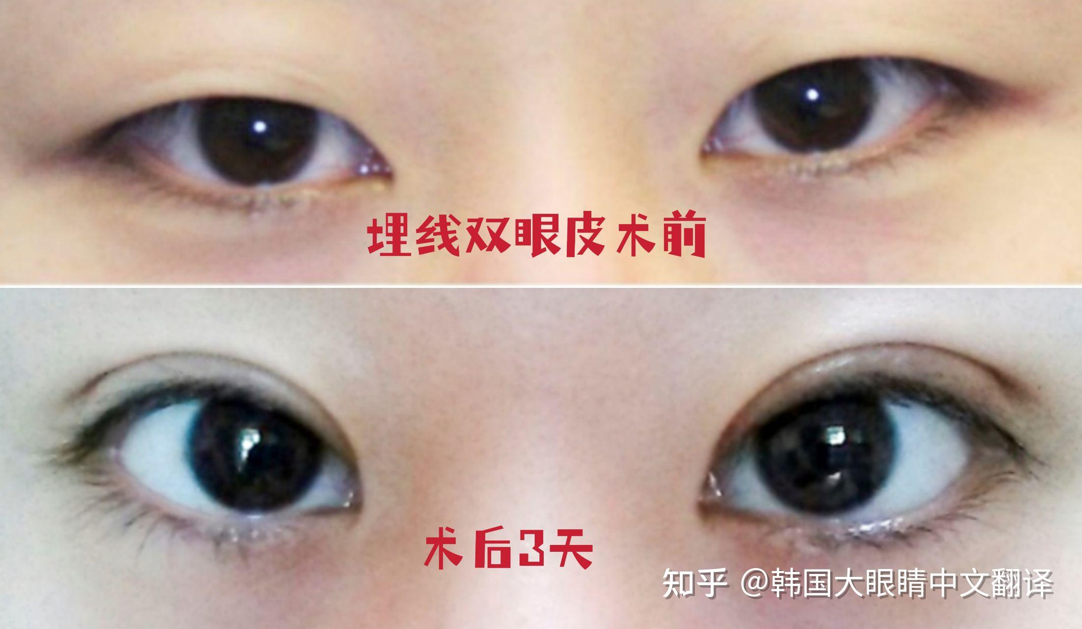 快看这些双眼皮手术后照片更喜欢哪个？ - 知乎