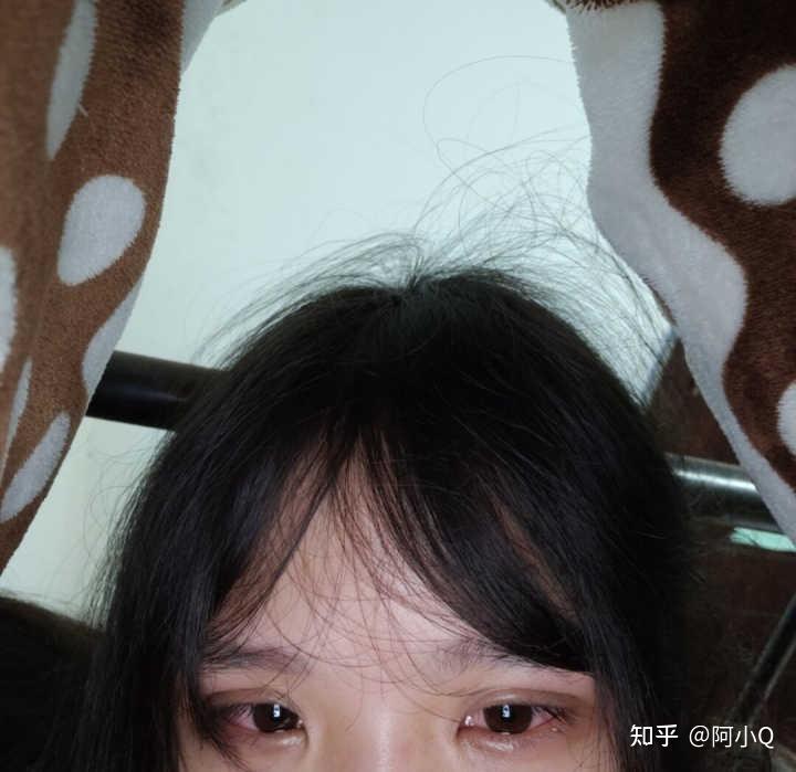 敏感肌爱出油脸上痘印特别明显多久可以改善好有什么可以有效去痘印的