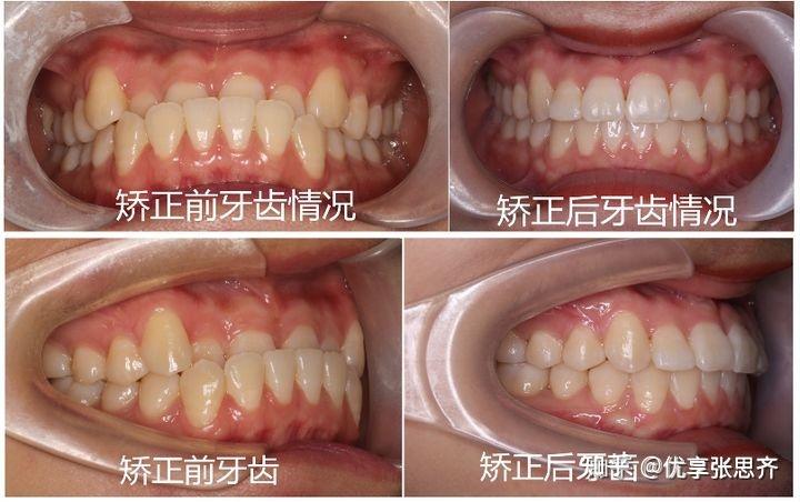 矯正後:牙齒咬合關係改善,上牙正常覆蓋下牙,覆合正常.牙齒排列整齊.