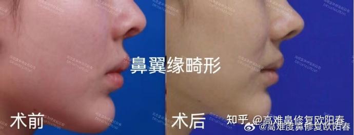 怎么纠正鼻翼缘退缩? - 知乎