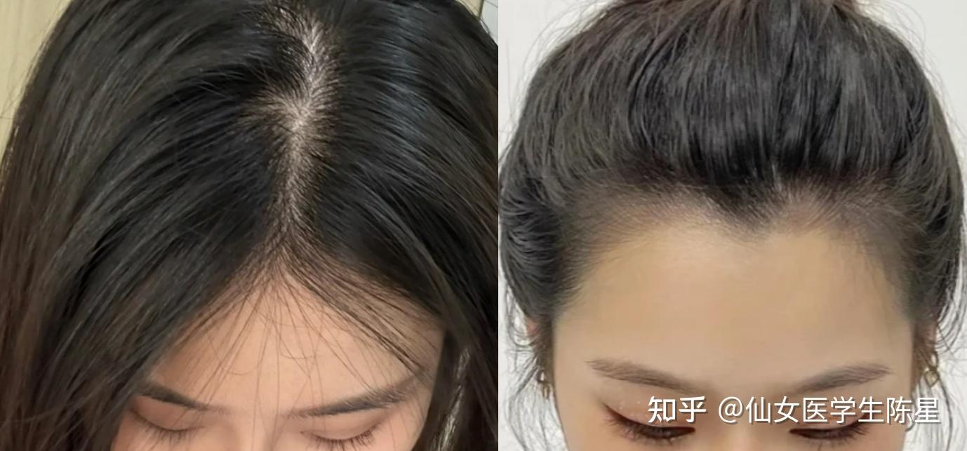 发缝比海宽、发际线贼高、不停掉头发,怎么样让头发【长回来】?皮肤科医生教你科学【防脱长头发】方法,40天改善发缝发际线,恢复发丝健康生长! - 知乎