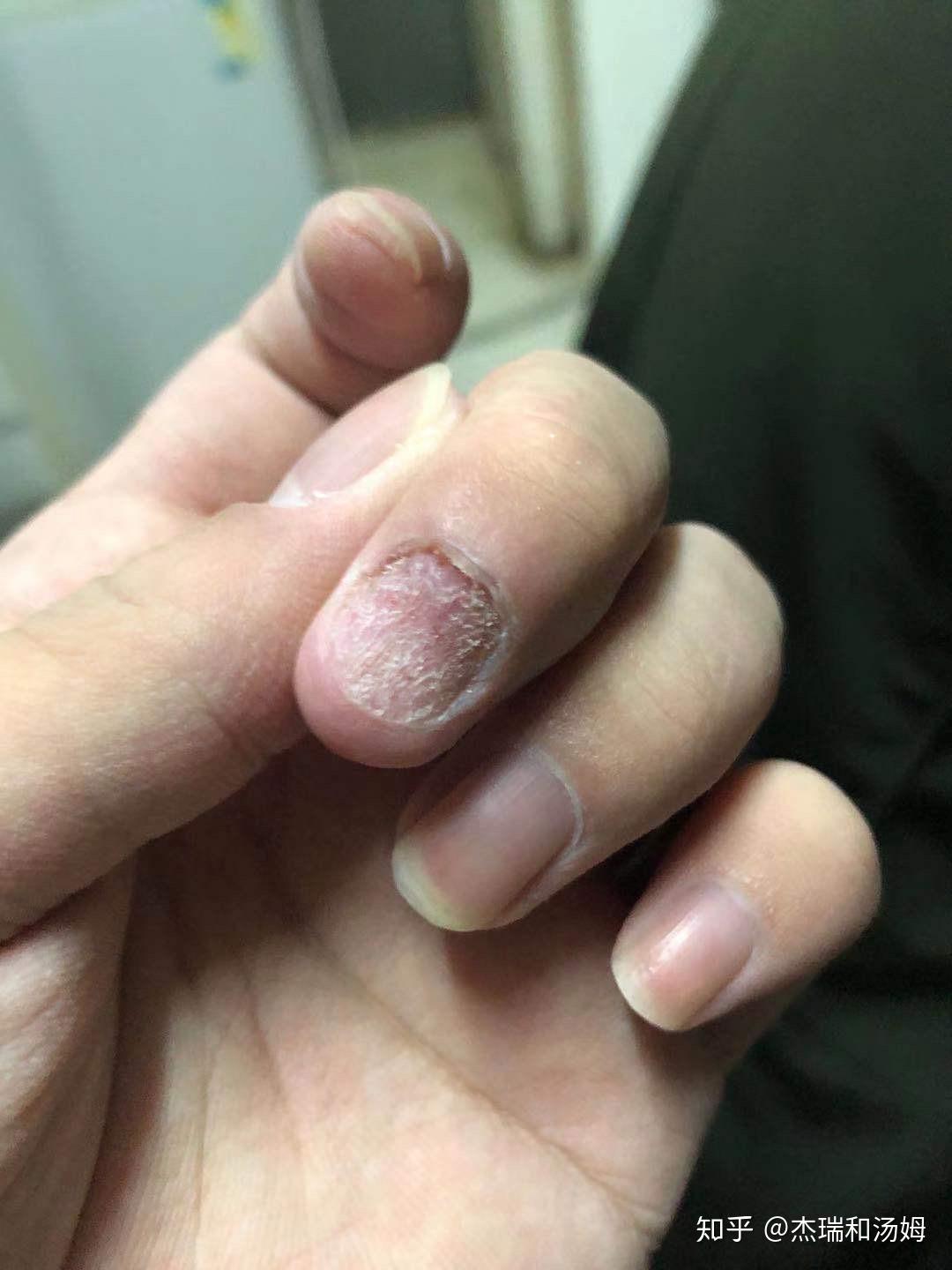 我们如何判断自己的是不是灰指甲以及目前治疗灰指甲方法有哪些