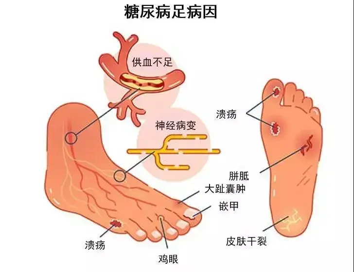 关于糖尿病足的tips 