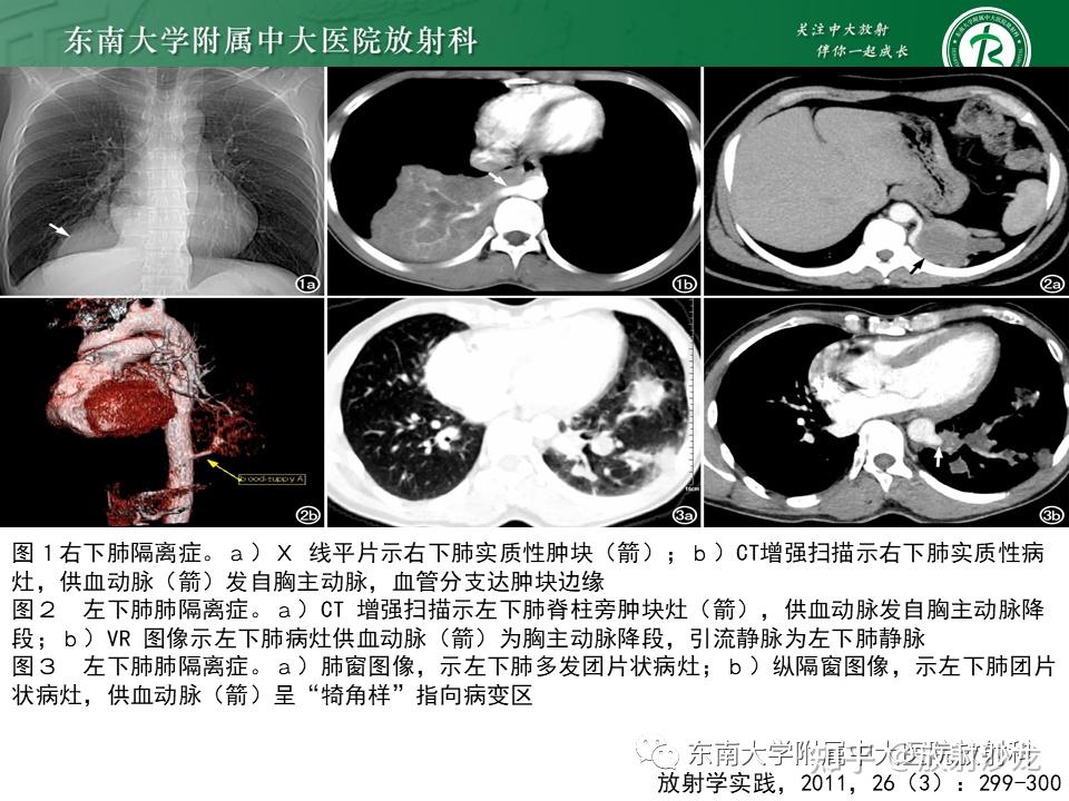 肺隔离症ct表现图片