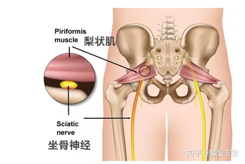 梨状肌综合征 导致臀部疼痛的罪魁祸首 知乎