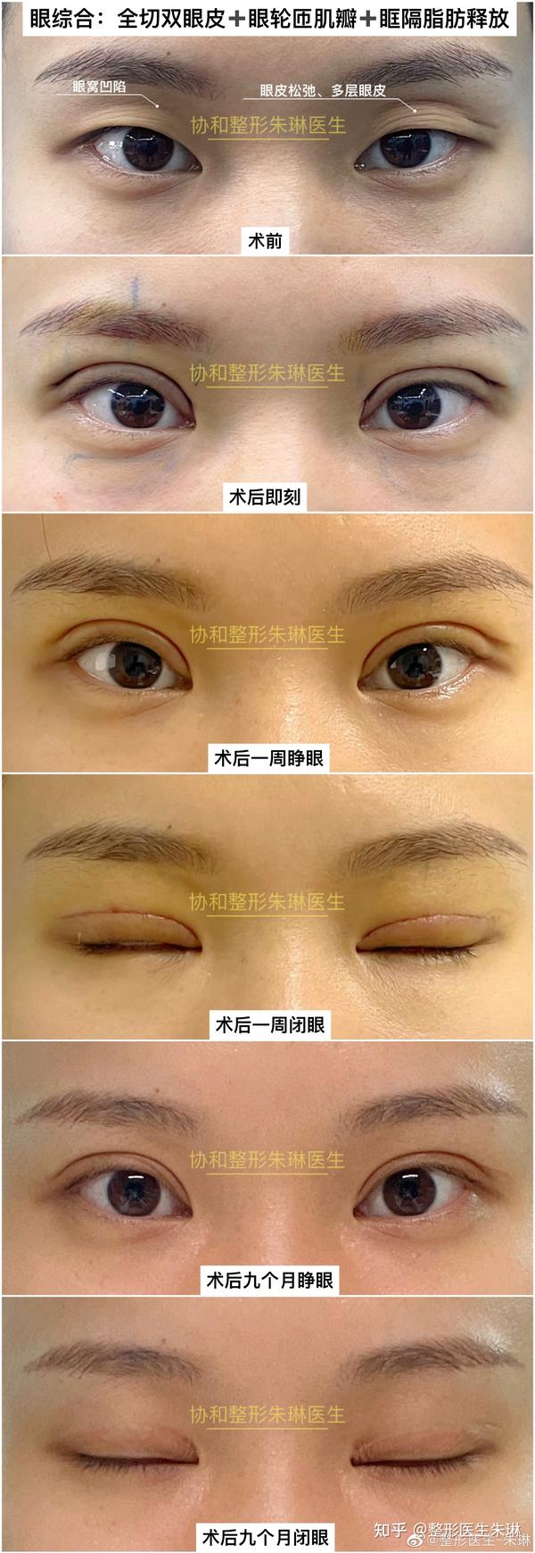 北京全切双眼皮 眼轮匝肌瓣 眶隔脂肪释放 术后九个月 - 知乎