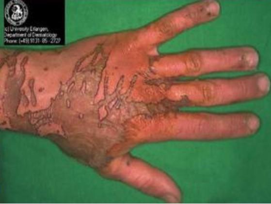 化学烧伤氢氟酸灼伤多可怕