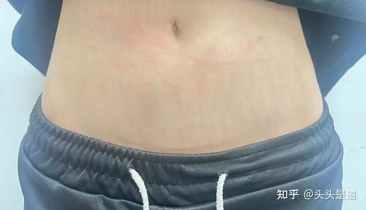 烫伤留下疤痕要怎么办,祛疤膏能淡化掉吗,想找一款淡化疤痕的祛疤膏!! - 知乎