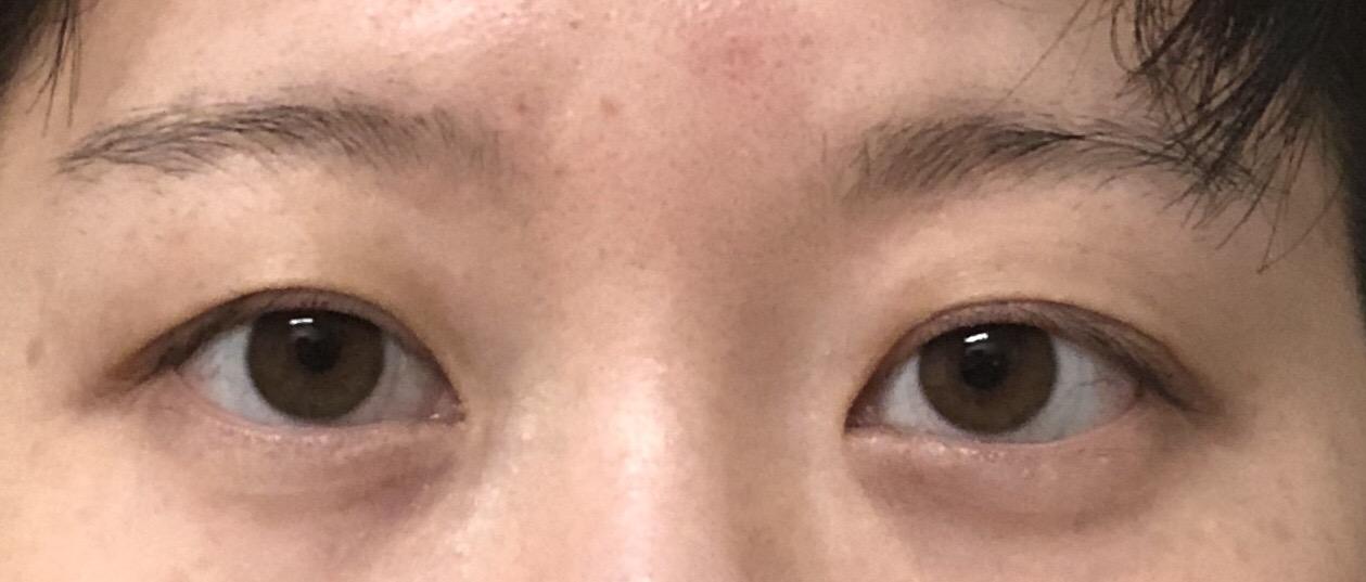 长时间戴眼镜引起眼睛的变形这该怎么矫正