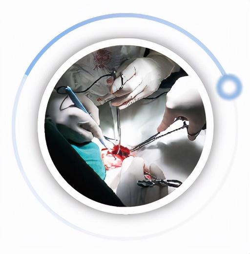 普外科的应用:氩气刀适用于实质性脏器与有大面积出血倾向的手术.