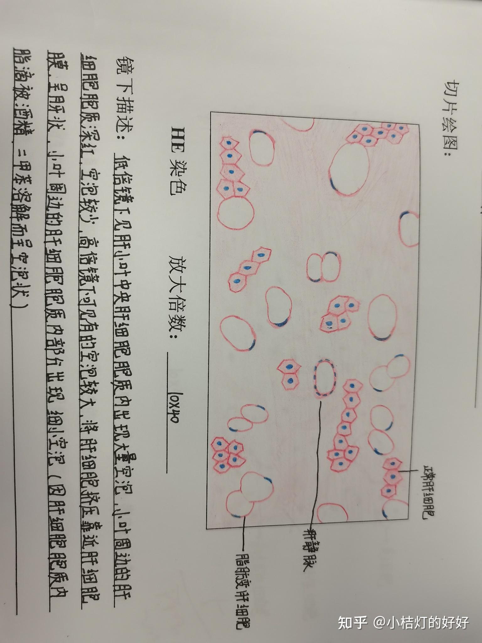 肺淤血图片红蓝铅笔图片