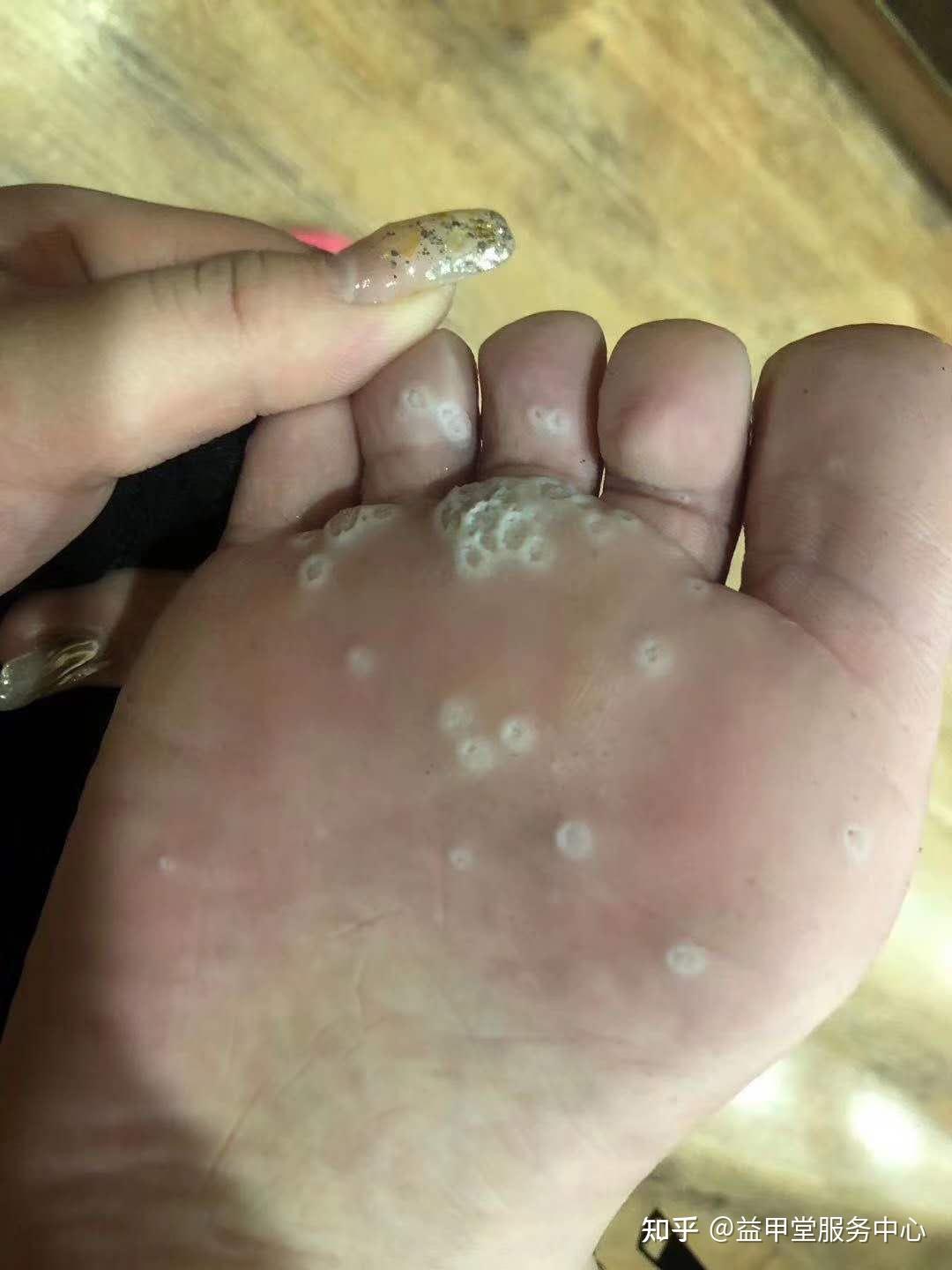 脚上小疙瘩一定要看看是什么