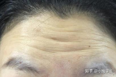 你的纹路是假性细纹还是真性皱纹？ - 知乎
