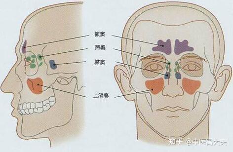 鼻竇炎怎麼引起的鼻竇炎頭痛怎麼回事鼻竇炎治療方法是什麼