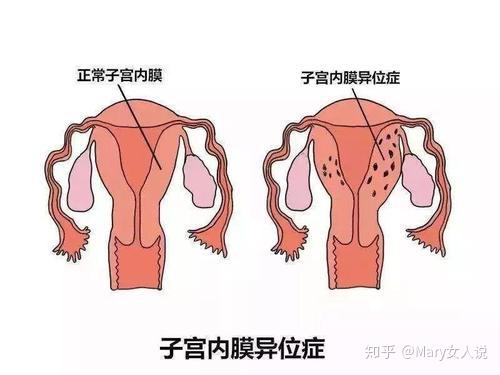 这些异位的内膜可以出现在肚脐,膀胱,肾,输尿管,肺,乳房,甚至是手臂