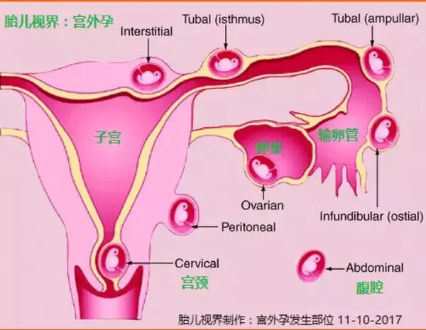 何谓宫外孕 宫外孕的胎儿能顺利生长吗 能要吗 兼谈宫外孕的超声显像特点 知乎