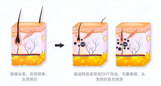 治疗脂溢性脱发,需要解决这两个问题