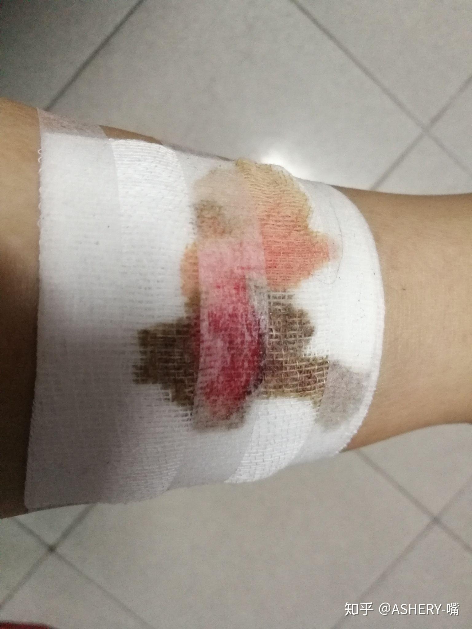 奇妙的一次受伤