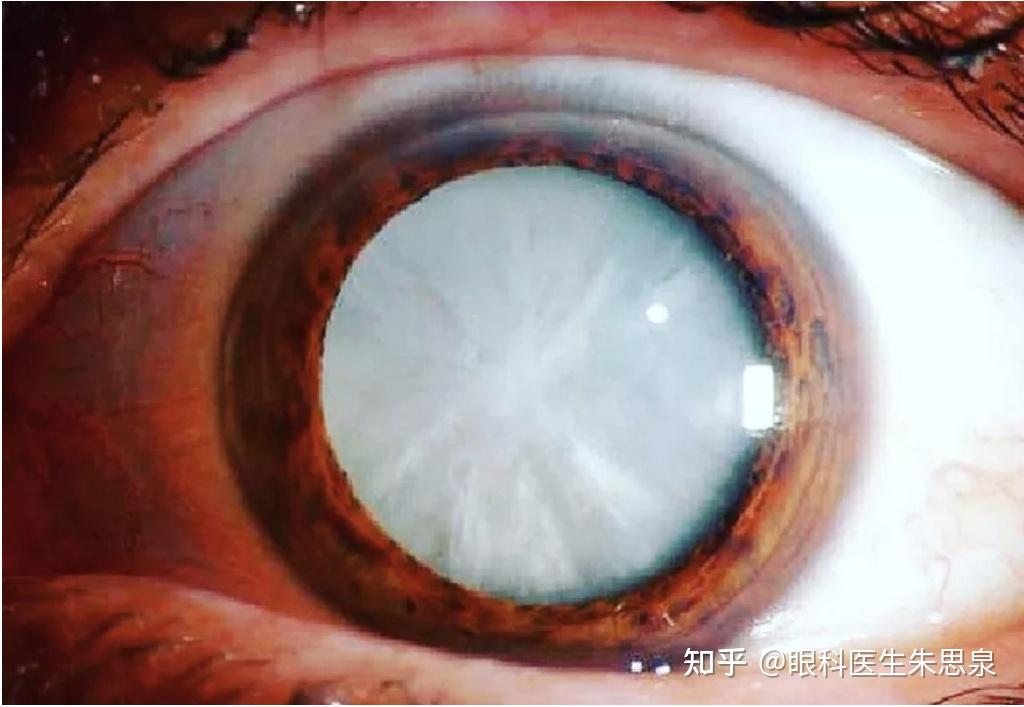 白内障手术什么时候做最合适白内障有哪些危害