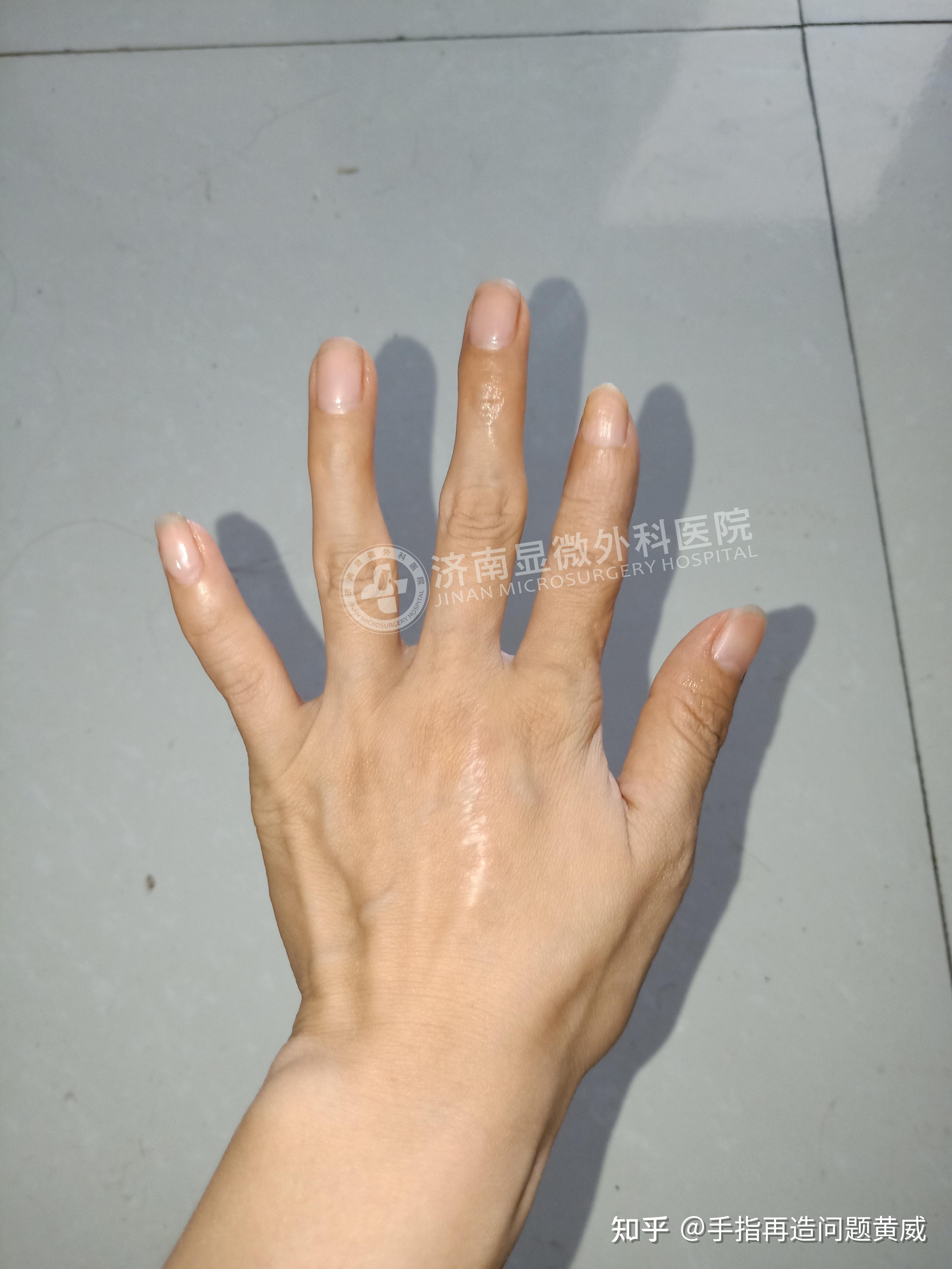 【手指再造案例】重塑美丽人生之神奇的“3D全形手指再造术” - 知乎