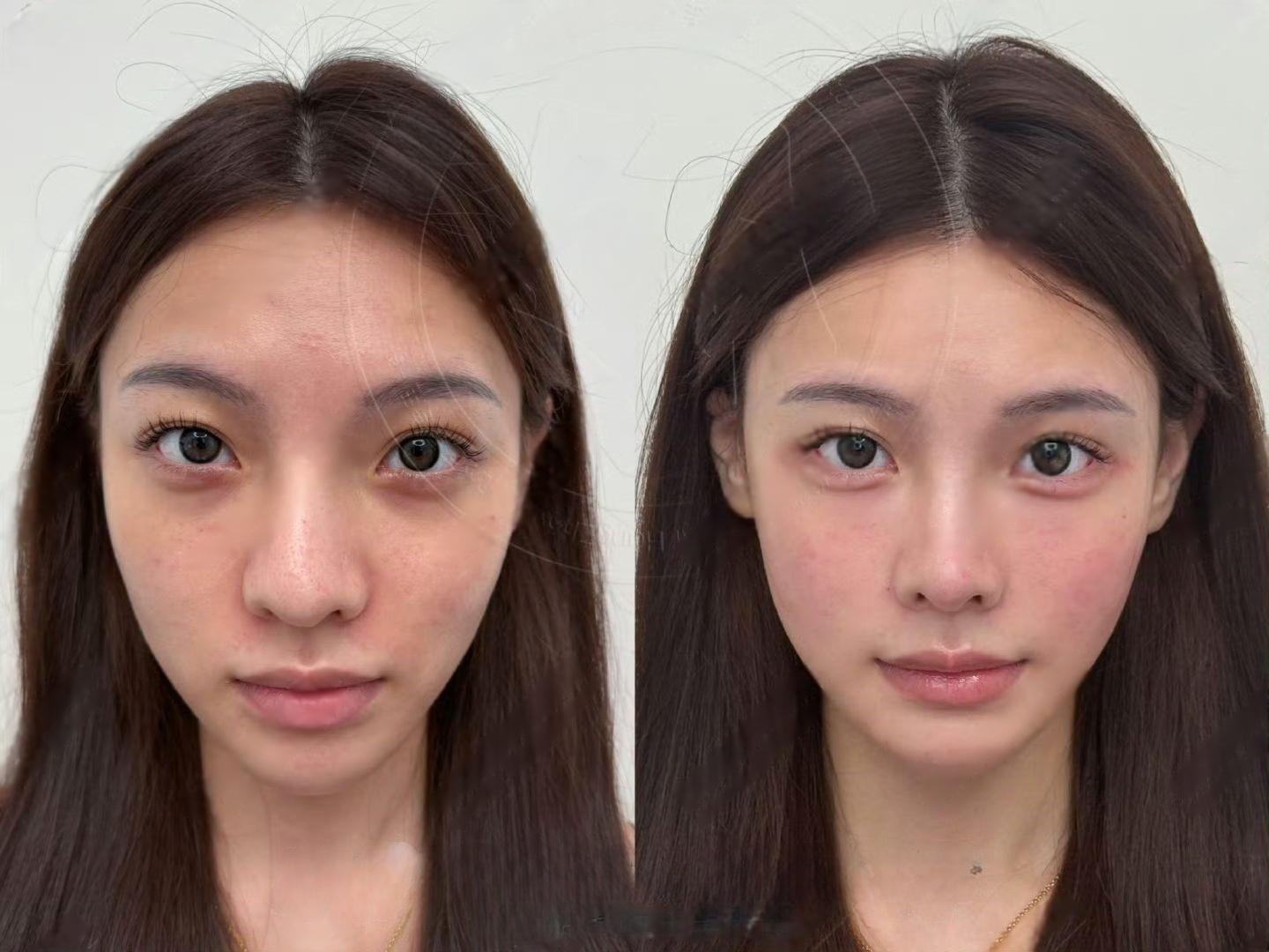 上了30岁以后的美貌，都是靠钱和自律来维持的。童颜针和少女针，面部年轻化的一剂猛药，钱是真能买到时间啊，贵妇就没有不爱的。 - 知乎
