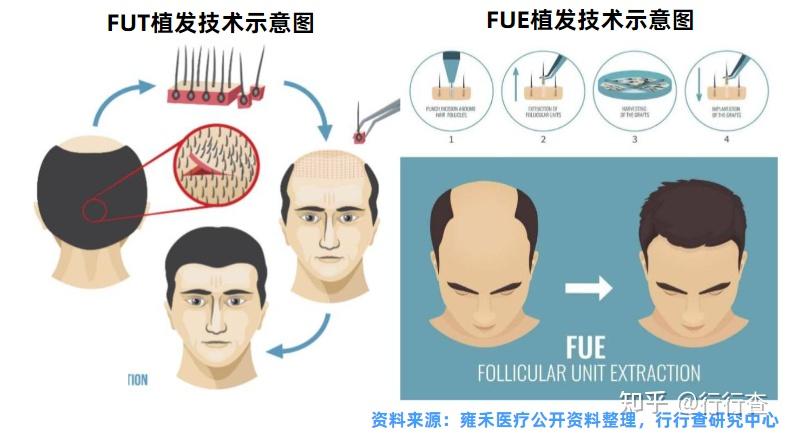 2021年中国毛发医疗行业研究报告 - 知乎