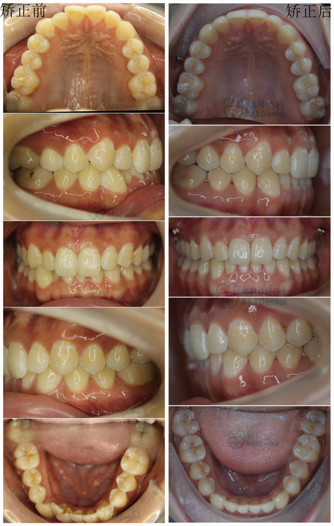 在种植钉支抗协助下利用智齿空间推磨牙向远中,压低下前
