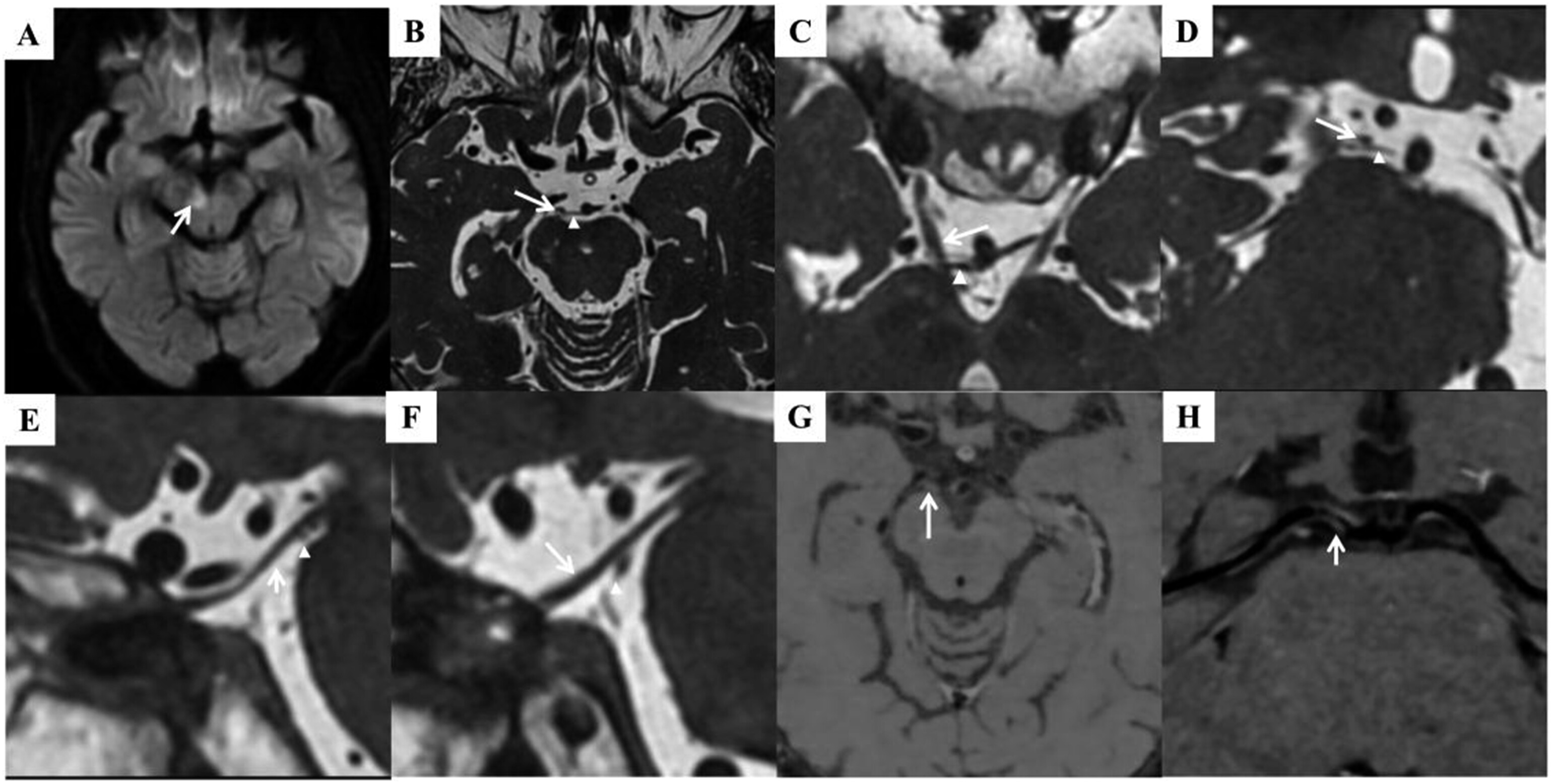 Clinical Reasoning A 74YearOld Woman Presenting With Monocular Ptosis and Binocular Diplopia 知乎