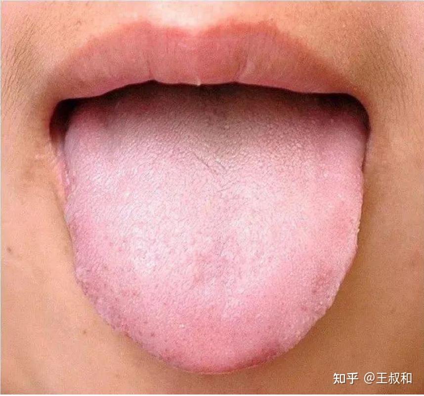 王叔和一文教会你中医舌诊基础知识 - 知乎