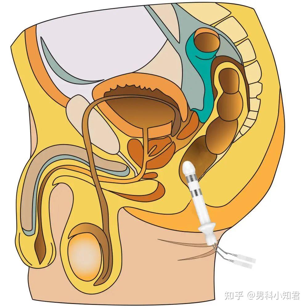漏尿便秘肛门坠胀怎么办凯戈尔为男性盆底保驾护航