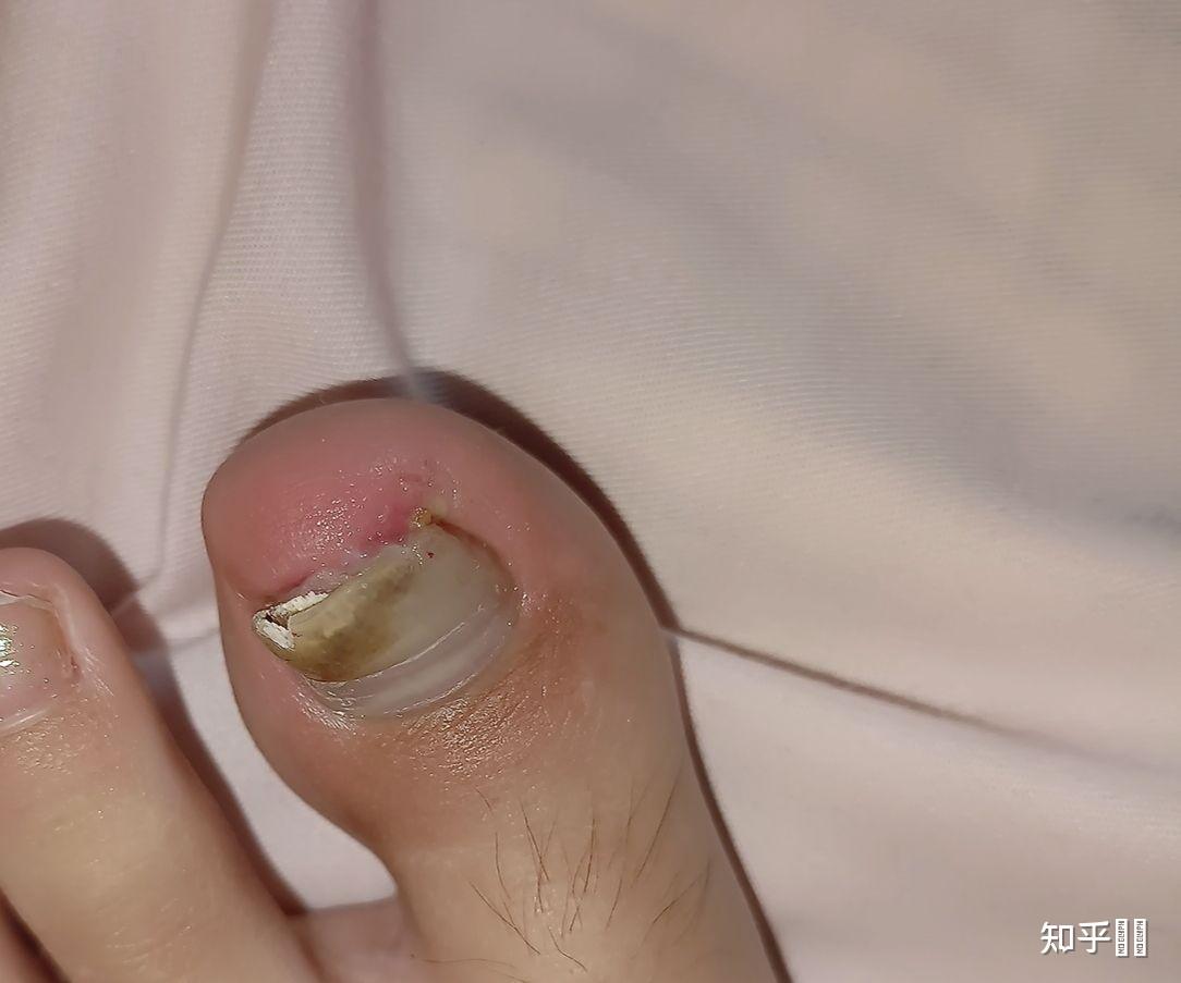 大脚趾甲有一条特别深的横纹看起来跟裂开了一样想请教一下这是怎么