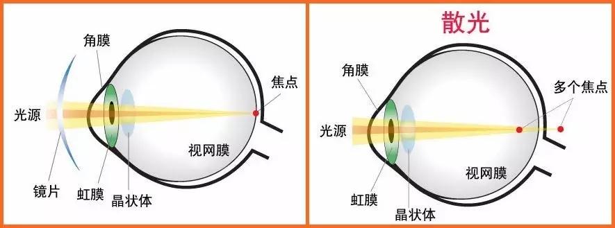看近看远都不清晰,怎么办?有散光的孩子看过来了! - 知乎