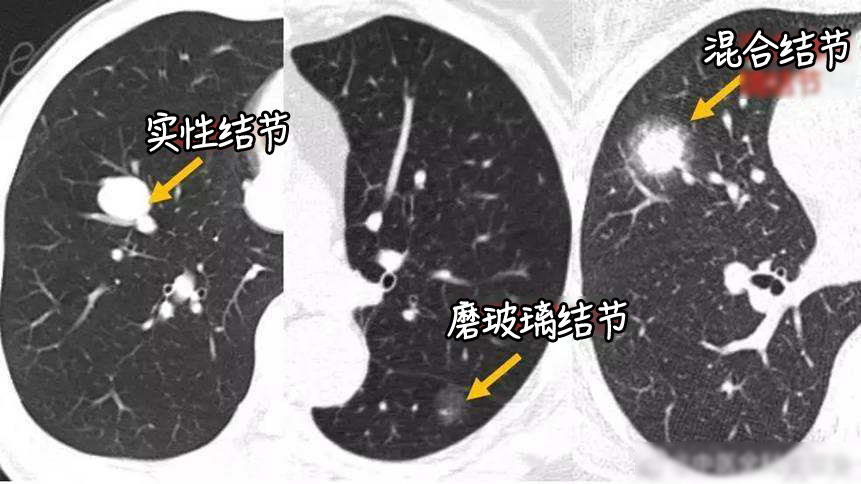 肺结节离癌还有多远