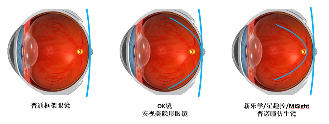 目前所有近视防控的光学产品基本都基于同一个原理:近视离焦原理,让一