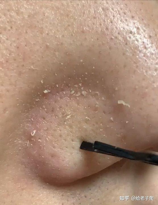 三,控油去黑头!