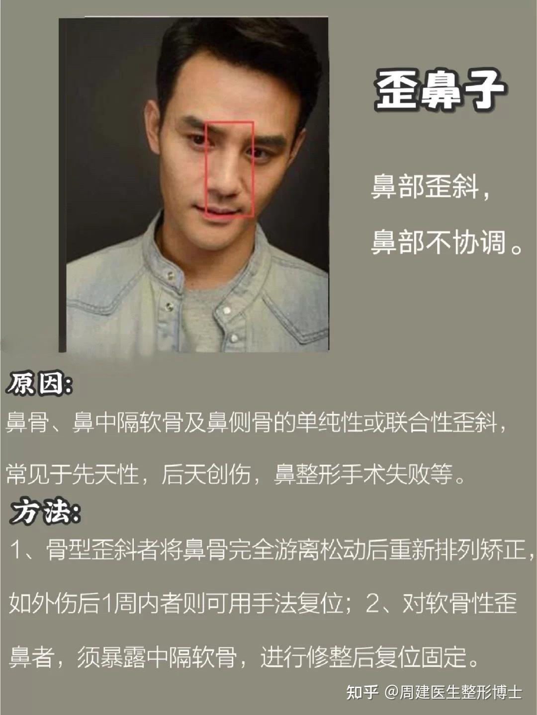 666种常见不完美鼻型究竟该怎么办71