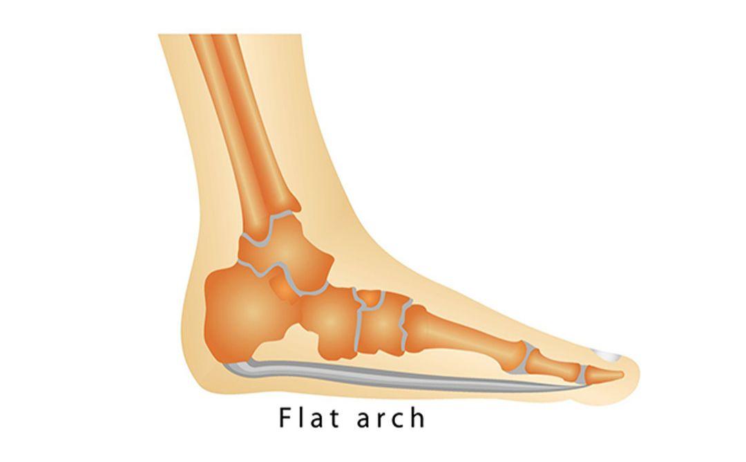 最容易被忽视的「足弓」问题,却足以影响全身