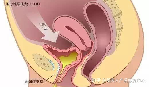 明夫人產後恢復產後陰道鬆弛子宮脫垂尿失禁怎麼辦