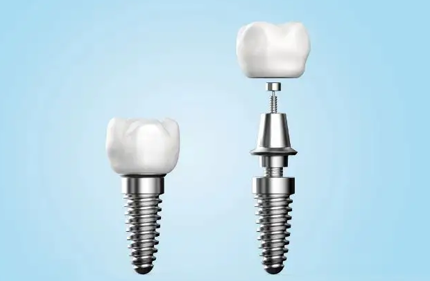 三,杭州瑞典诺贝尔种植体寿命多久?